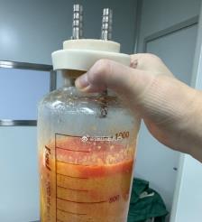 庆阳水动力吸脂手术要做多久？